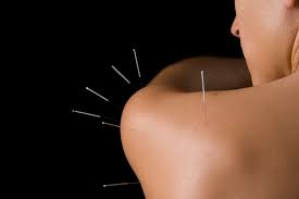Acupuncture & Dry Needling